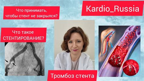 🫀 Что пить из лекарств, чтобы стент не закрылся? Стентирование - это ...