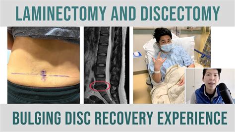 Laminectomy And Discectomy Surgery Experience From A Bulging Disc To