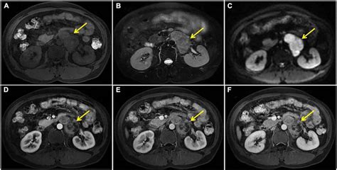 Magnetic Resonance Imaging Mri Findings Low Signal On T1wi And