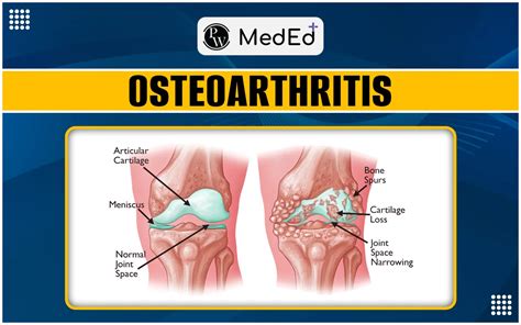 Osteoarthritis Types Causes Symptoms Diagnosis