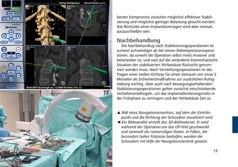 Wirbels Ule Operative Therapie Patienteninformation Bei Degenerativen