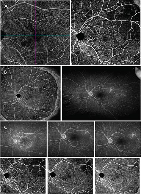 Retinal Physician Pentavision