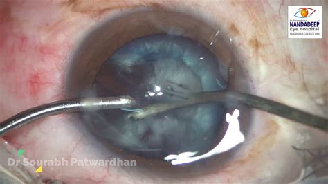 Post Traumatic Cataract With Ruptured Anterior Capsule Dr Sourabh Patwardhan Youtube