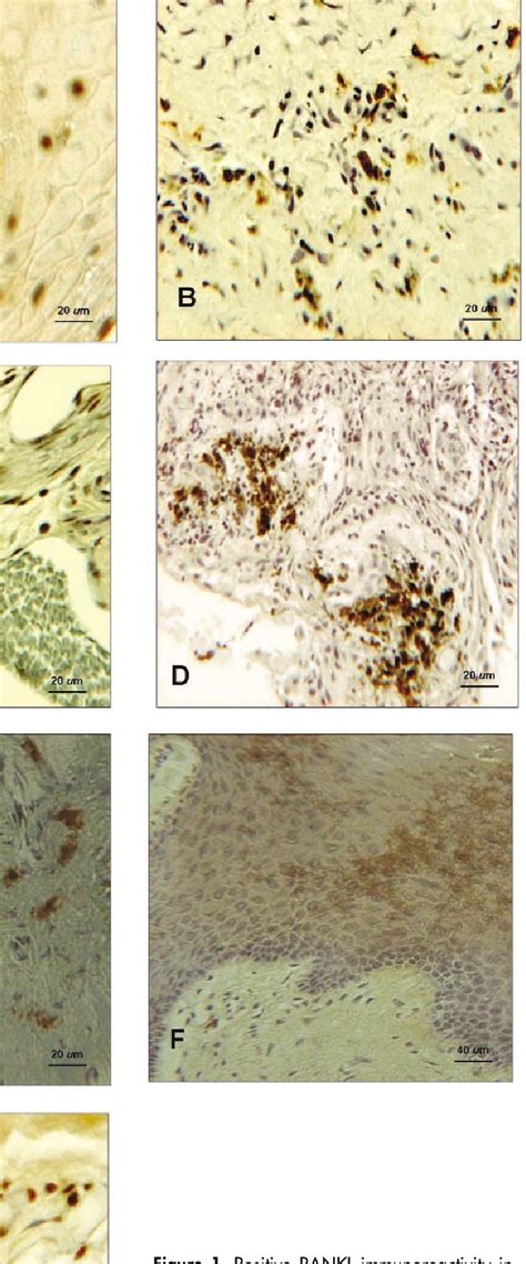 Figure 1 From Identification Of Rankl In Osteolytic Lesions Of The