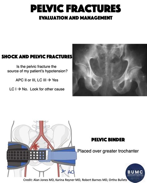 Pelvic Fractures Bumcem