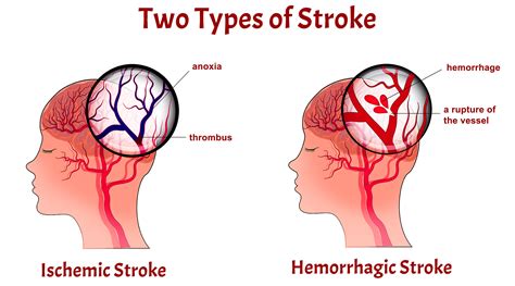 Different Types Of Strokes