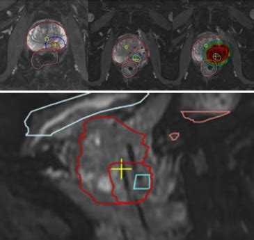 The Effect Of Catheter Displacement And Anatomical Variations On The