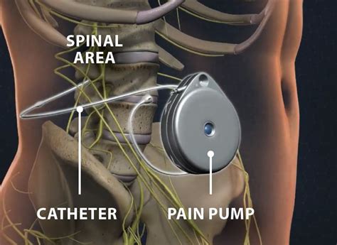 What is a Pain Pump - PMCOA