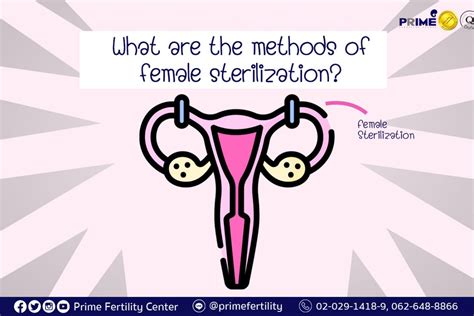 What Are The Methods Of Female Sterilization Prime Fertiltiy Clinic