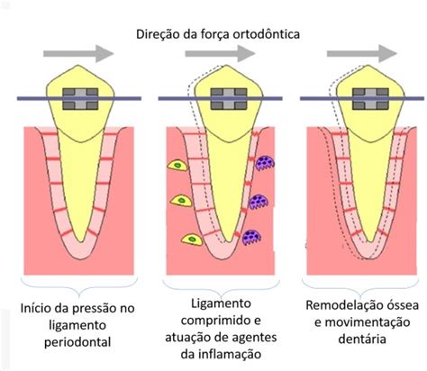 movimentação aparelho ortodontico Dentista Porto Alegre Zona Norte