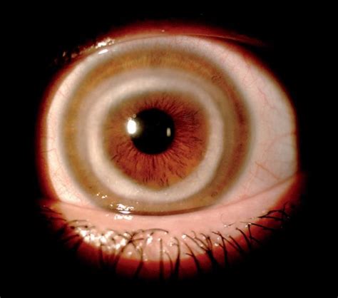 What Caused This Eerie White Ring in a Woman's Eye? | Live Science