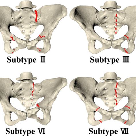 Von Mises Stress Distributions For The Whole Pelvis In Lc 1 Fracture Download Scientific