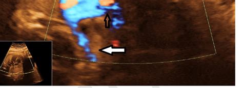 Aberrant Right Subclavian Artery Depicted By Color Doppler