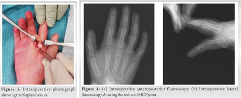 Complex Metacarpophalangeal Joint Dislocation Kaplans Lesion Of The