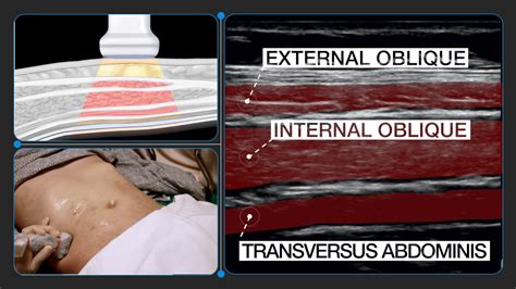 How To Correctly Identify Anatomy For Transversus Abdominis Plane Tap