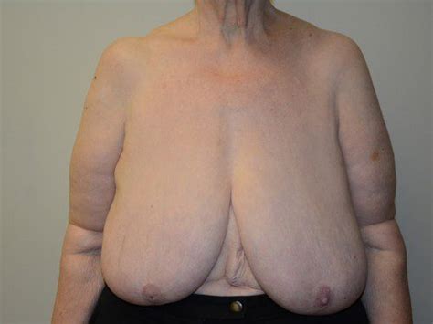 Breast Reduction 01 Before After Gallery Allen Doezie MD FACS