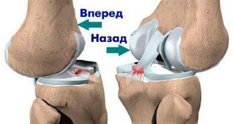 Наиболее характерным симптомом при свежем разрыве мениска является ...