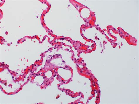 Fat Embolism Dr Yale Rosen Atlas Of Pulmonary Pathology Flickr