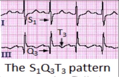 Electrocardiogram Findings In Pulmonary Embolism Download Scientific