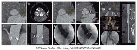 Role Of Computed Tomography In Transcatheter Coronary And Structural