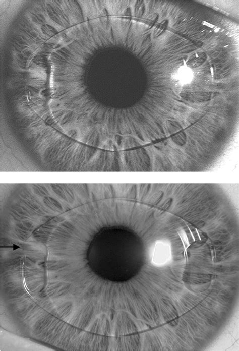 Late Onset Decentration Of Iris Fixated Phakic Intraocular Lenses A