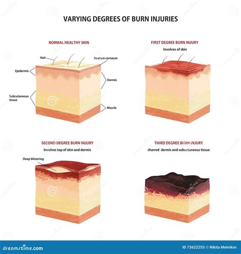 Skin Burn Classification Cartoon Vector 73622255