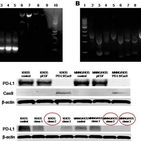 Expression Of Pd L1 Protein In Osteosarcoma Cell Lines And Osteosarcoma