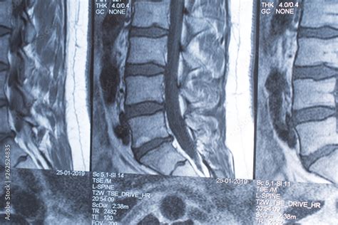 Lumbar Spine L S Disc Hot Sex Picture