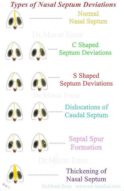 Nasal Septum Deviation Symptoms Diagnosis And Treatment