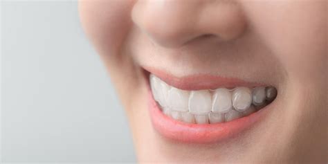 clear aligners cost explained key factors smart options