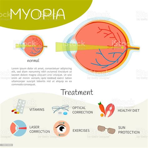 Infographics Of Myopia Stock Illustration Download Image Now