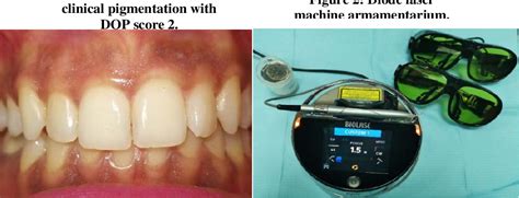 Figure 2 From Diode Laser Ablation Versus Surgical Scalpel Technique