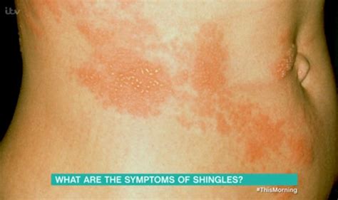 Shingles Symptoms Dr Chris Outlines Two Early Signs To Spot On Itv