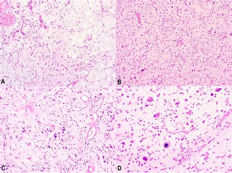 Myxoid Pleomorphic Liposarcomaa Clinicopathologic Immunohistochemical