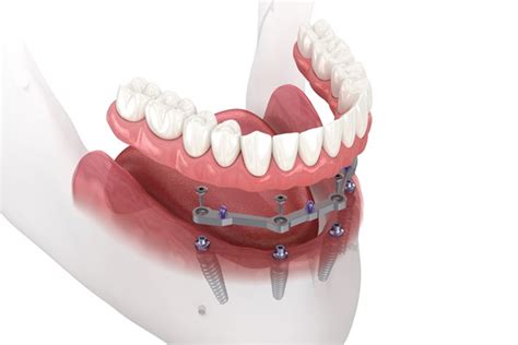 A Brief Comparison Between Implant Supported Dentures And Traditional