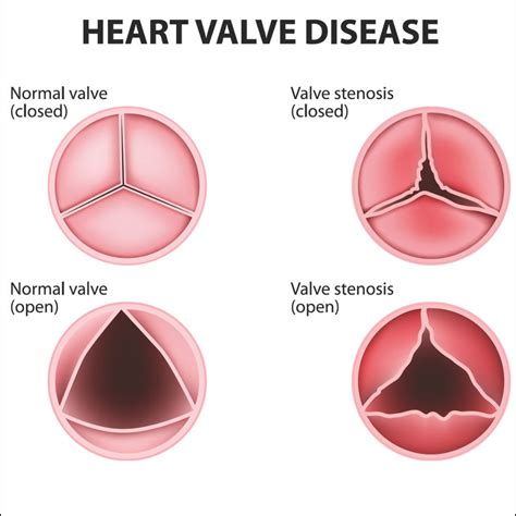 Heart Valve Disease Causes Risk Factors Symptoms Treatment