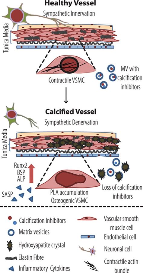 Medial Arterial Calcification Arteriosclerosis Thrombosis And