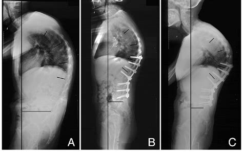 Figure From Risk Factor Analysis Of Proximal Junctional Kyphosis