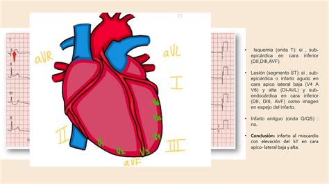 Cardiopatía Isquemica definicion diagnostico y tratamiento pptx