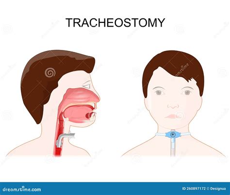 Traqueotom A Vista Lateral Del Cuello Y Colocaci N De Un Tubo De