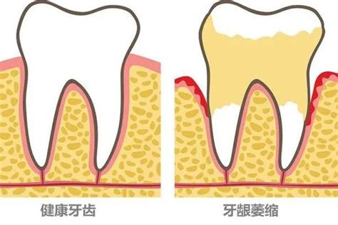 中年人牙龈萎缩怎么恢复？不同原因导致的萎缩恢复方式不同 知乎