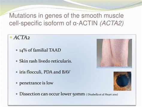 Ppt The Role Of Genetic Testing In Aortic Aneurysm Disease Powerpoint