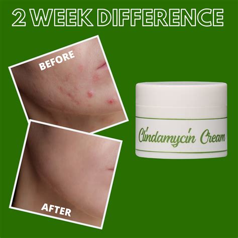 Greenika Clindamycin Cream Anti Acne Gel Greenika Ph