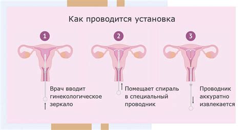 Установка внутриматочной спирали в Москве: цены, поставить ВМС у ...