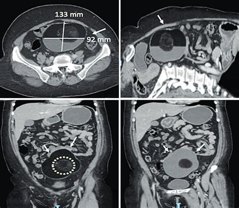 Tomografía de abdomen contrastada Corte axial A y corte sagital B