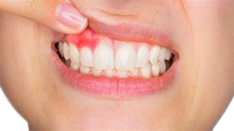 Receding Gums Symptoms Diagnosis Causes And Treatment