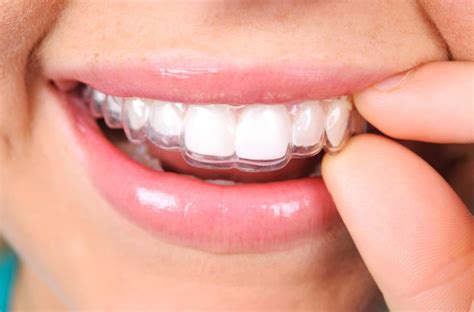 The Pros And Cons Of Invisalign Vs Braces Th Ave Dental Care