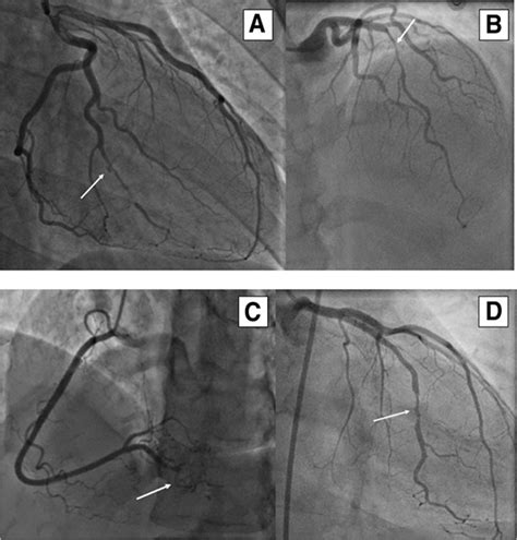 Fmd And Scad Sex Biased Arterial Diseases With Clinical And Genetic