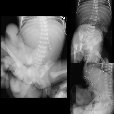 Newborn With Anterior Abdominal Wall Defect Pediatric Radiology Case