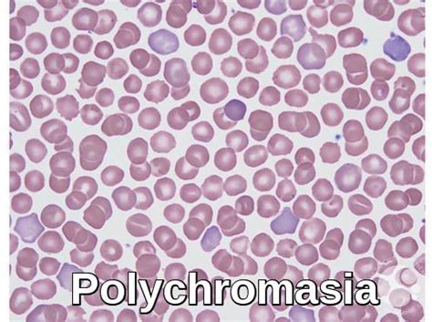 Blood Morphology Ask Hematologist Understand Hematology